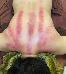 Ảnh minh họa dịch vụ Cạo gió